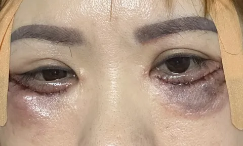Cắt mí giá rẻ 5 triệu đồng, mắt người phụ nữ không khép lại được phải cầu cứu bác sĩ